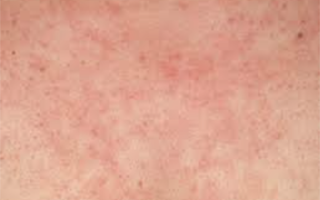 Eczema: What it is, Causes and Treatment